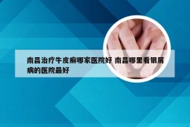 南昌治疗牛皮癣哪家医院好 南昌哪里看银屑病的医院最好
