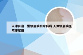天津有治一型银屑病的专科吗 天津银屑病医院哪家强