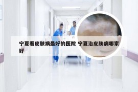 宁夏看皮肤病最好的医院 宁夏治皮肤病哪家好