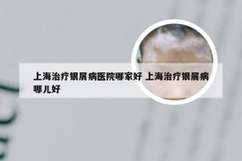 上海治疗银屑病医院哪家好 上海治疗银屑病哪儿好