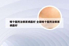 哪个医院治银屑病最好 全国哪个医院治银屑病最好