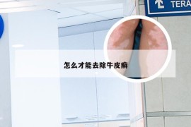 怎么才能去除牛皮癣