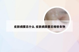 皮肤病要忌什么 皮肤病需要忌哪些食物