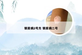 银屑病2号方 银屑病二号