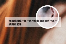 银屑病很痒一抓一大片疙瘩 银屑病为什么一挠就鼓起来