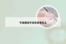 牛皮癣会不会长在龟头上