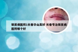 银屑病医院1长春华山真好 长春专治银屑病医院哪个好