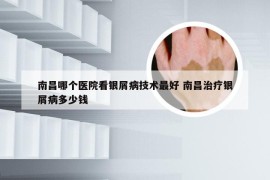 南昌哪个医院看银屑病技术最好 南昌治疗银屑病多少钱