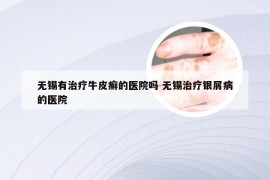 无锡有治疗牛皮癣的医院吗 无锡治疗银屑病的医院