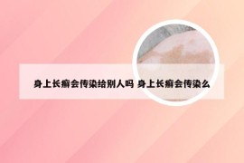身上长癣会传染给别人吗 身上长癣会传染么