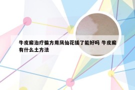 牛皮廨治疗偏方用凤仙花插了能好吗 牛皮廨有什么土方法