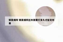 银屑病阿 银屑病阿达木需要打多久才能见效果