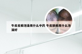 牛皮皮癣泡澡用什么中药 牛皮肤癣用什么泡澡好