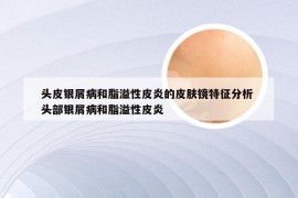 头皮银屑病和脂溢性皮炎的皮肤镜特征分析 头部银屑病和脂溢性皮炎
