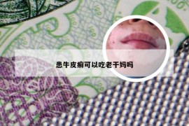 患牛皮癣可以吃老干妈吗