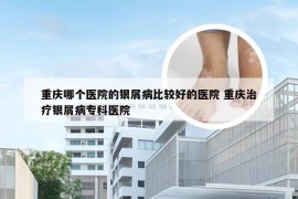 重庆哪个医院的银屑病比较好的医院 重庆治疗银屑病专科医院