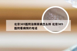 北京305医院治银屑病怎么样 北京305医院看病预约电话