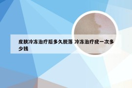 皮肤冷冻治疗后多久脱落 冷冻治疗疣一次多少钱