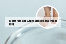白癞风初期是什么样的 白癞风早期发现能治好吗
