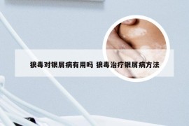 狼毒对银屑病有用吗 狼毒治疗银屑病方法