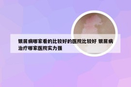 银屑病哪家看的比较好的医院比较好 银屑病治疗哪家医院实力强