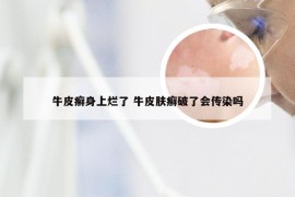 牛皮癣身上烂了 牛皮肤癣破了会传染吗