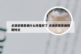 点滴状银屑病什么样是好了 点滴状银屑病初期特点