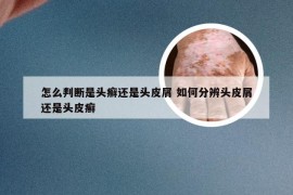 怎么判断是头癣还是头皮屑 如何分辨头皮屑还是头皮癣