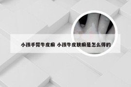 小孩手臂牛皮癣 小孩牛皮肤癣是怎么得的