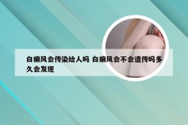 白癞风会传染给人吗 白癞风会不会遗传吗多久会发现