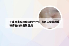 牛皮癣市玫瑰糠诊的一种吗 有医生说是玫瑰糠疹有的说是银屑病