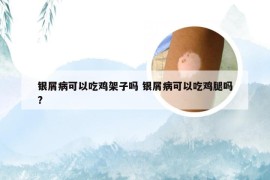银屑病可以吃鸡架子吗 银屑病可以吃鸡腿吗?