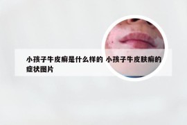 小孩子牛皮癣是什么样的 小孩子牛皮肤癣的症状图片
