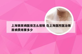 上海银屑病医保怎么报销 在上海医院医治银屑病费用要多少