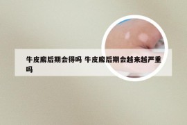 牛皮廨后期会得吗 牛皮廨后期会越来越严重吗