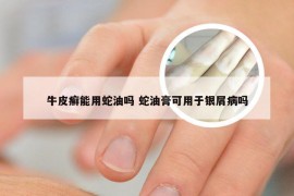 牛皮癣能用蛇油吗 蛇油膏可用于银屑病吗