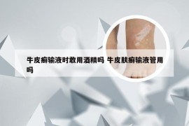 牛皮癣输液时敢用酒精吗 牛皮肤癣输液管用吗