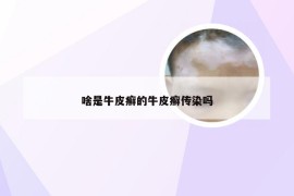 啥是牛皮癣的牛皮癣传染吗