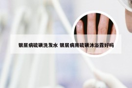 银屑病硫磺洗发水 银屑病用硫磺沐浴露好吗