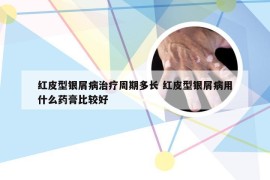 红皮型银屑病治疗周期多长 红皮型银屑病用什么药膏比较好