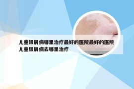儿童银屑病哪里治疗最好的医院最好的医院 儿童银屑病去哪里治疗