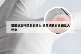 银屑病三种现象表现为 银屑病具有诊断三大现象
