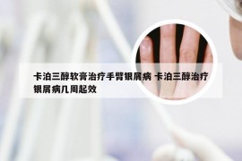 卡泊三醇软膏治疗手臂银屑病 卡泊三醇治疗银屑病几周起效