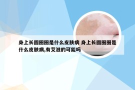 身上长圆圈圈是什么皮肤病 身上长圆圈圈是什么皮肤病,有艾滋的可能吗