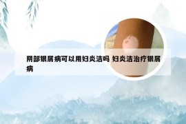 阴部银屑病可以用妇炎洁吗 妇炎洁治疗银屑病