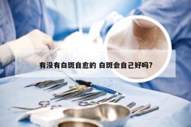 有没有白斑自愈的 白斑会自己好吗?