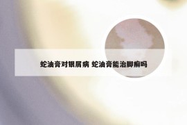 蛇油膏对银屑病 蛇油膏能治脚癣吗