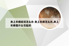 身上长癣应该怎么办 身上长癣怎么办,身上长癣是什么引起的