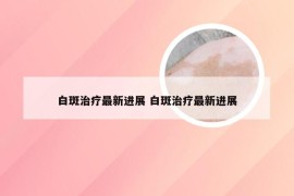 白斑治疗最新进展 白斑治疗最新进展
