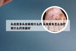头皮屑多头皮癣用什么药 头皮屑多怎么治疗用什么药膏最好